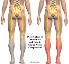 左臀部皮下2.4厘米处出现肿瘤会影响神经吗