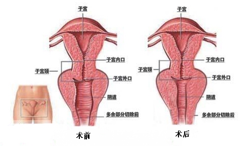 传统的手术是将阴道粘膜切除一块