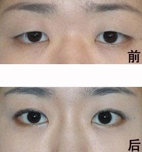 三点定位双眼皮_360百科